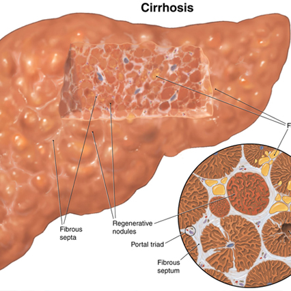 Liver cirrhosis 